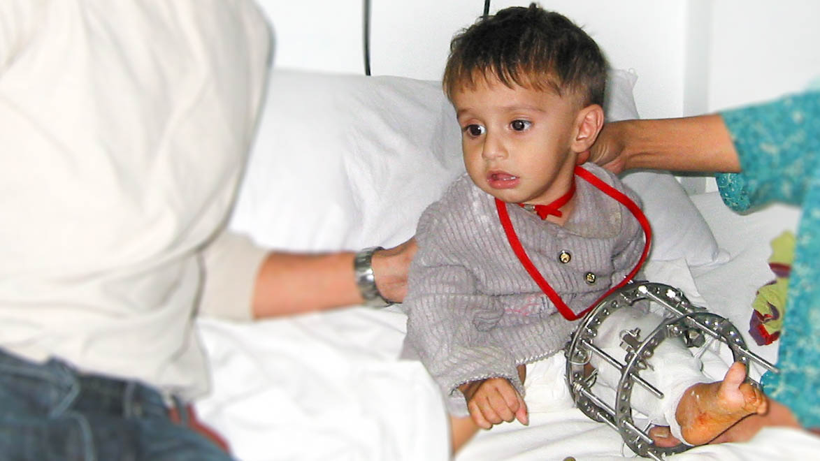 Pakistan 2005, Child with Ilizarov frame for open tibia fracture