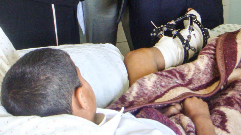 A boy in hospial in Gaza with an Ilizarov frame on his left leg